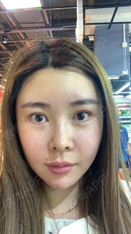 眉弓整形过的明星,揭秘整形后的明星风采